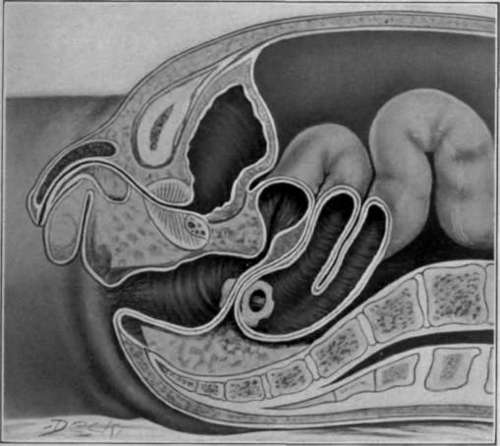 Fig. 55. Stricture of rectum. Bacon's lateral Anastasia 