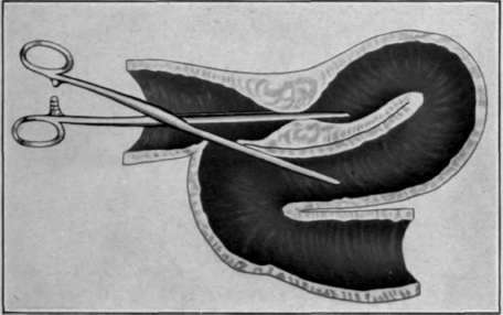 Fig 57. Bacon's operation Clamp