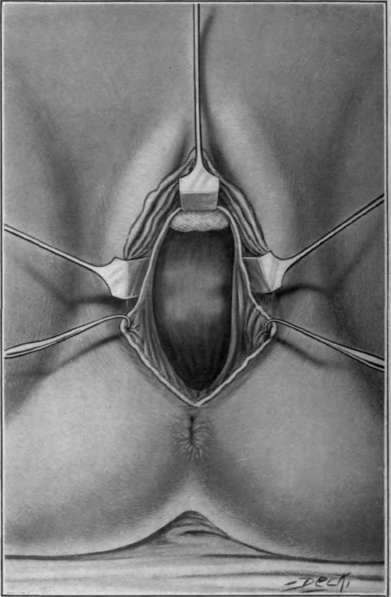 Fig. 85. Vaginal extirpation of rectum. Rectum cut open below neoplasm.