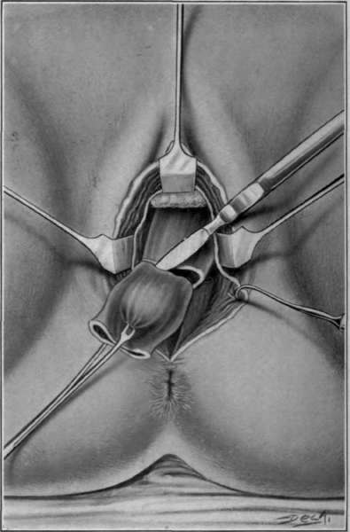 Fig. 87. Vaginal extirpation of rectum. 