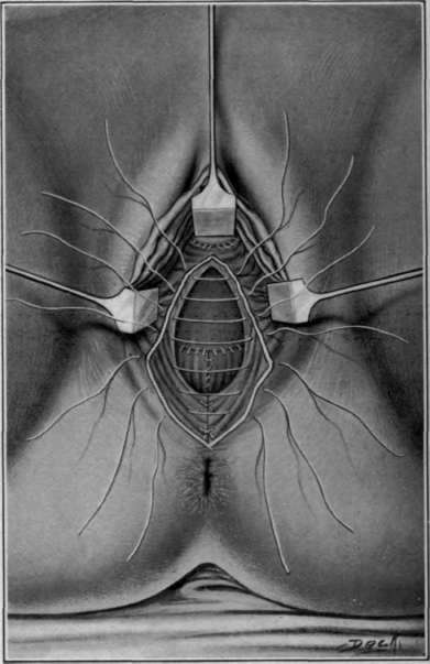 Fig. 89. Vaginal extirpation of rectum. Closure of vagina and peritoneal cavity.