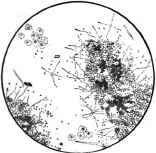 A Blackish Pellicle found in the Wash water of the Stomach (L. C    ).