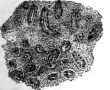 Group B (Beginning Atrophy). A piece of gastric mucosa (from patient B. E. situ carcinoma cardiae.