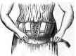 Means Serving To Decrease The Abdominal Space And 82