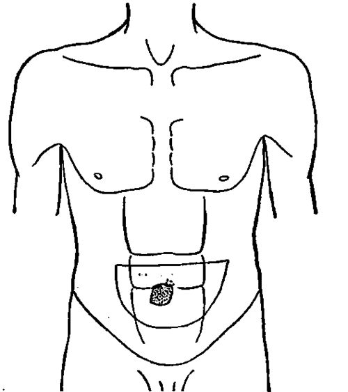 Transilluminated Zone of a Dilated Stomach (patient H. O.).