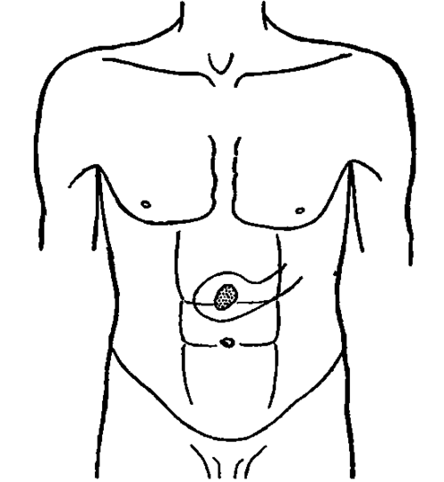 Transilluminated Zone of a Normal Stomach (M. S.).