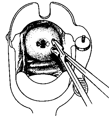 After painting the cervix