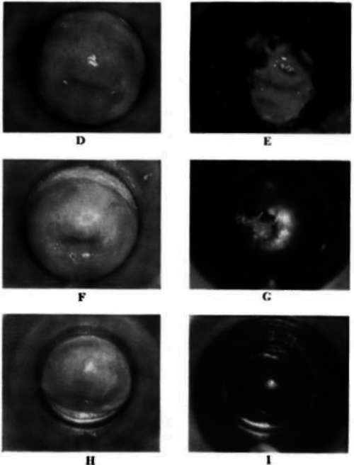 Chronic cervictis