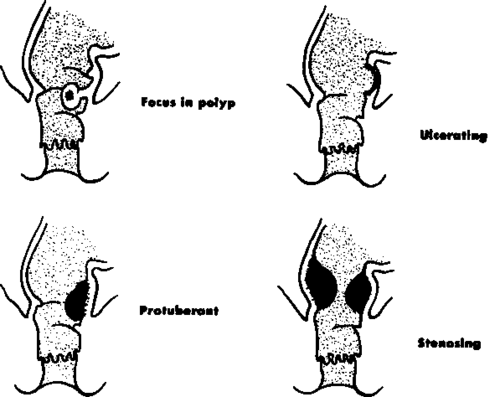  Cross classification of malignant lesions of the rectum