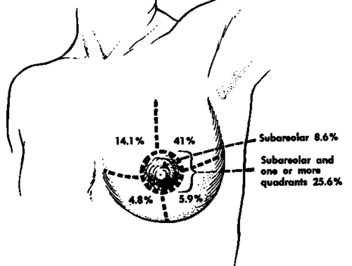 Distribution of cancer of the breast