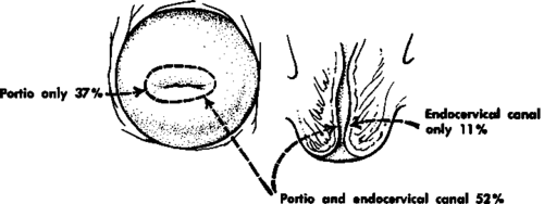 Distribution of in situ carcinoma of the cervix