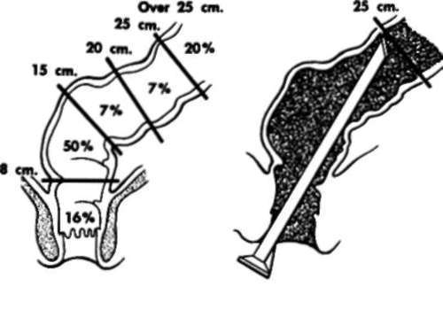Distribution of polyps of the rectum and colon