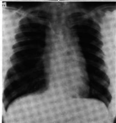 Hodgkin's disease, same patient, after therapy