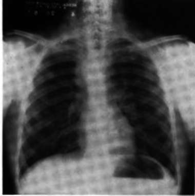 Hodgkin's disease