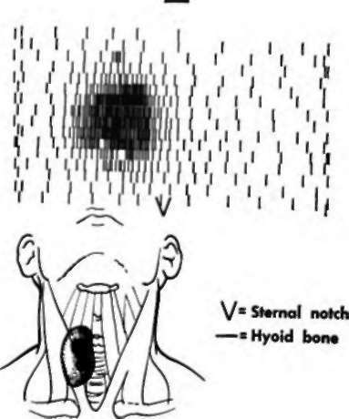 Hot nodule, right lobe of thyroid gland