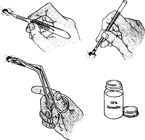 Incisional biopsy by scalpel