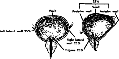 Location of cancers of the bladder