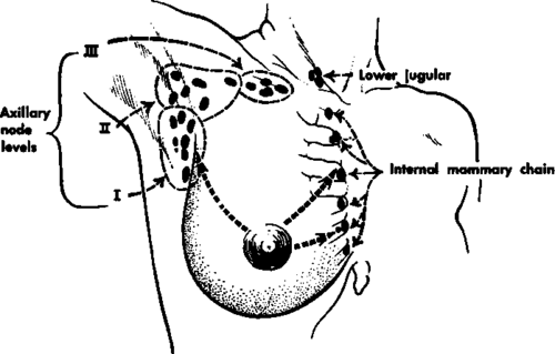 Pathways of spread of breast cancer