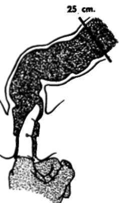 Relative value of sigmoidoscope and examining finger