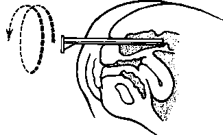 Removal of the sigmoidoscope in a rotary fashion