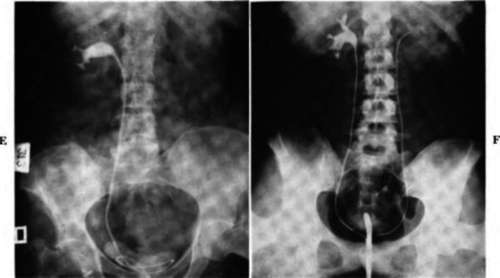 Right retrograde pyelograni showing a distortion of the calyces
