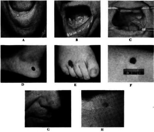 Squamous carcinoma