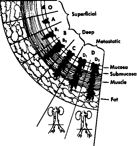 Staging of bladder cancer