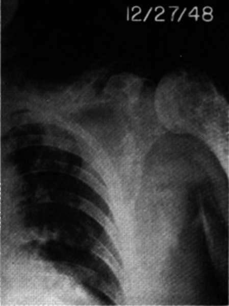 Anteroposterior view of left shoulder region in Case E.H.