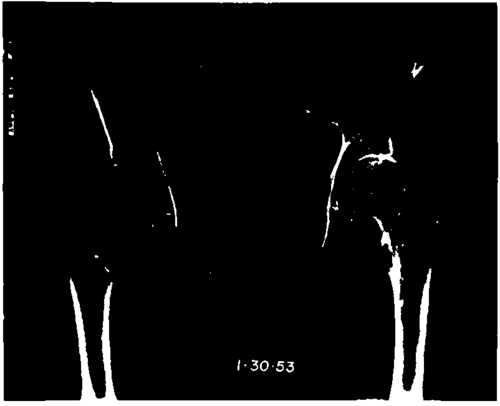 Anteroposterior view of the pelvis and femurs of patient (B.T.) 2 years later