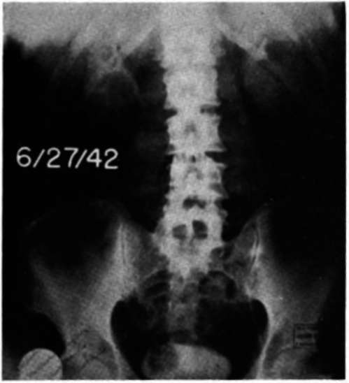 Cystogram of patient H.A. before treatment