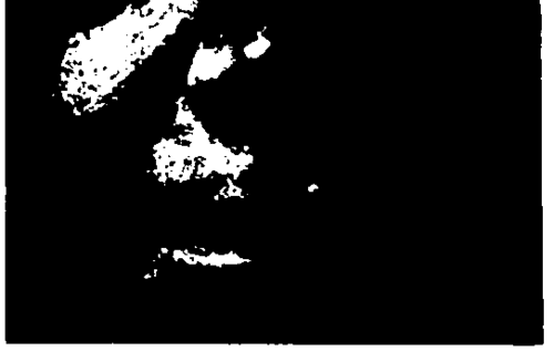 Patient G.Z. before treatment