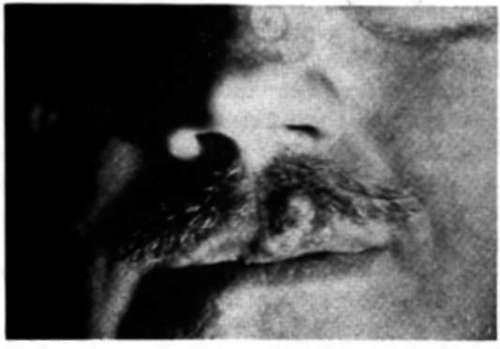 The tumor grew rapidly following biopsy