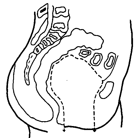 ANTERIOR PELVIC EXENTERATION