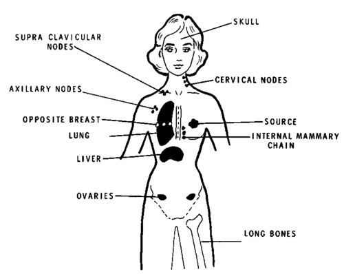 Breast Cancer Metastases