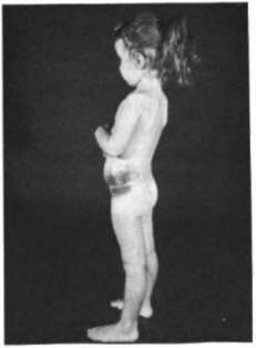 Children with acute leukemia