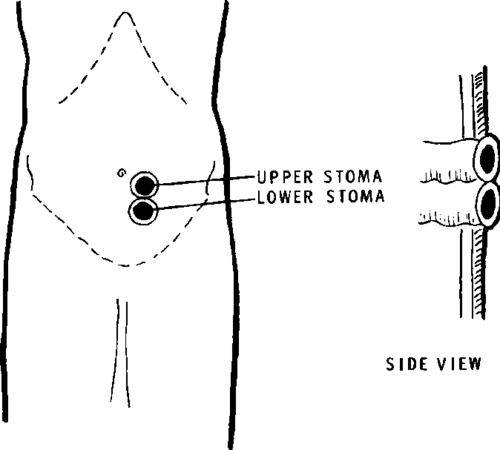 DOUBLE BARREL COLOSTOMY