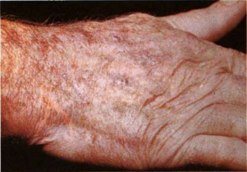 Keratoses of the Hand
