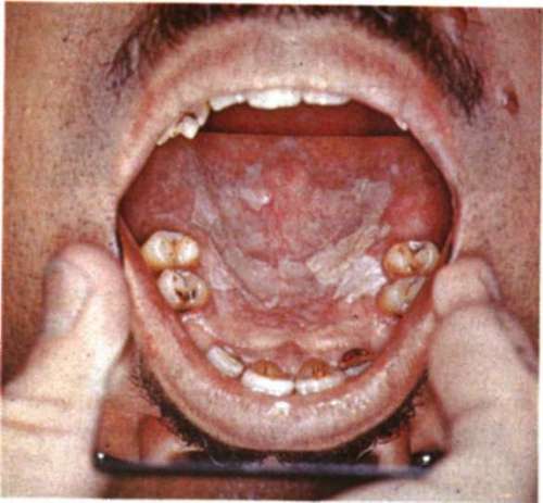 Leukoplakia of the Floor of the Mouth