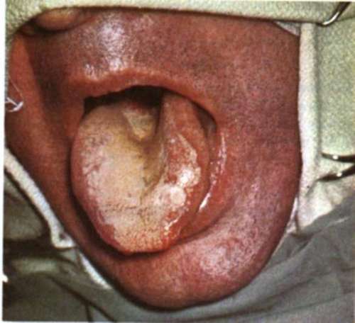 Leukoplakia of the Tonguo