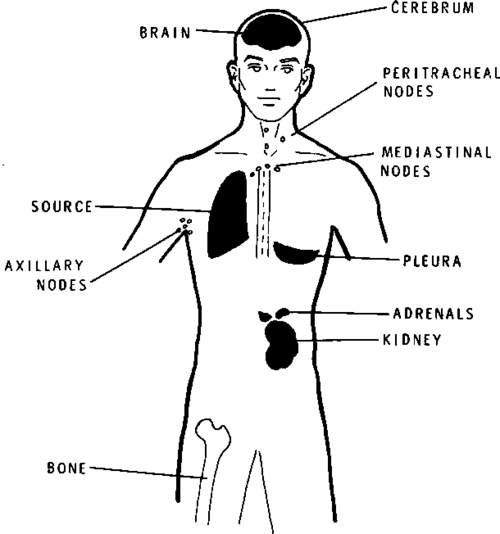 Lung Cancer Metastases