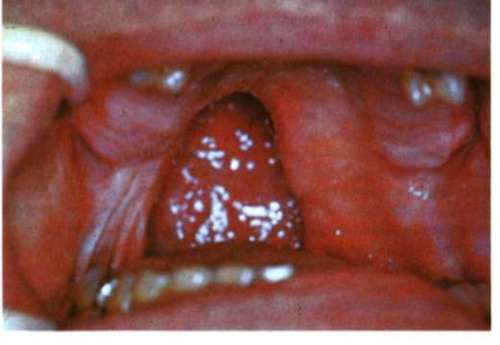 Oral Resection