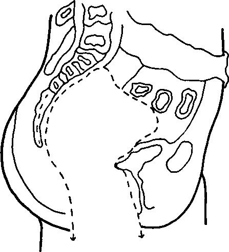 POSTERIOR PELVIC EXENTERATION