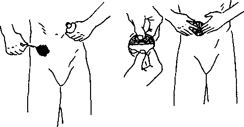 Paint area around artificial opening with tincture of benzoin