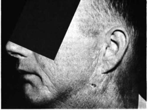 Skin reactions 3