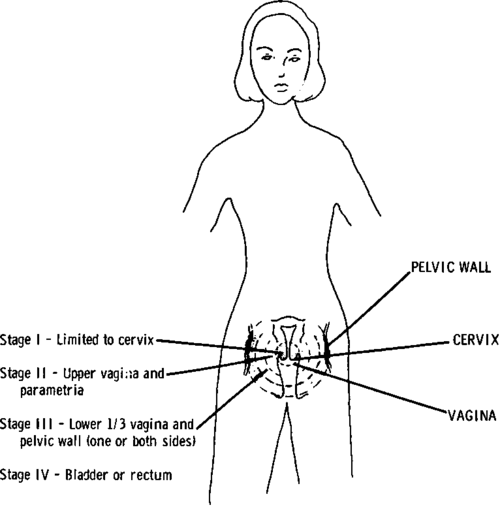 Spread Of Cervical Cancer