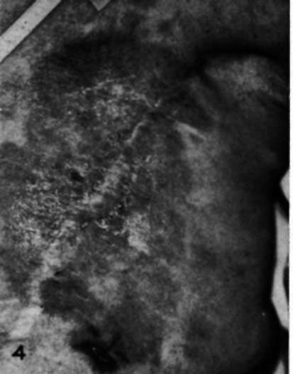 Appearance of mastectomy scar