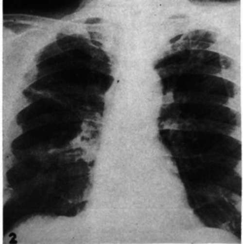 Roentgenogram of chest of a male with mammary cancer