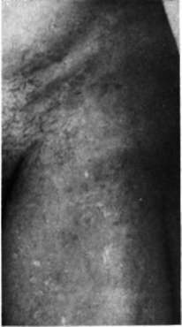 The same patient 8 years after orchiectomy