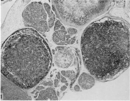 2 parotid tumor nodules