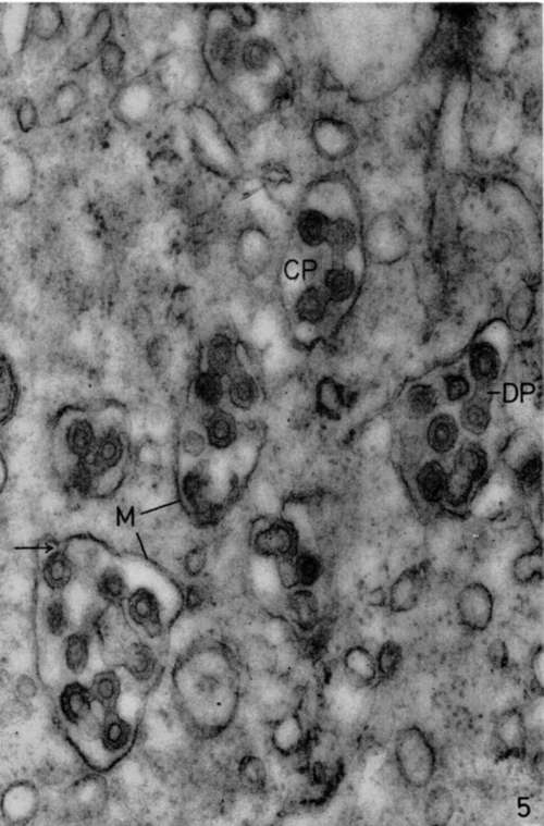Bone marrow of leukemic mouse